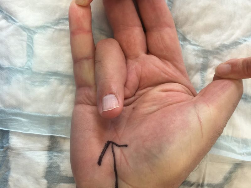 Hand affected by Dupuytren's disease before Dermofasciectomy